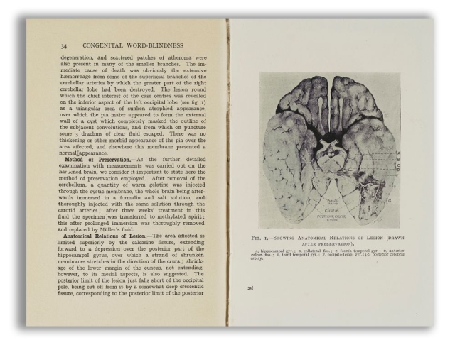 An image of the brain with a page of text from the book "Congenital word-blindness" by James Hinshelwood cc